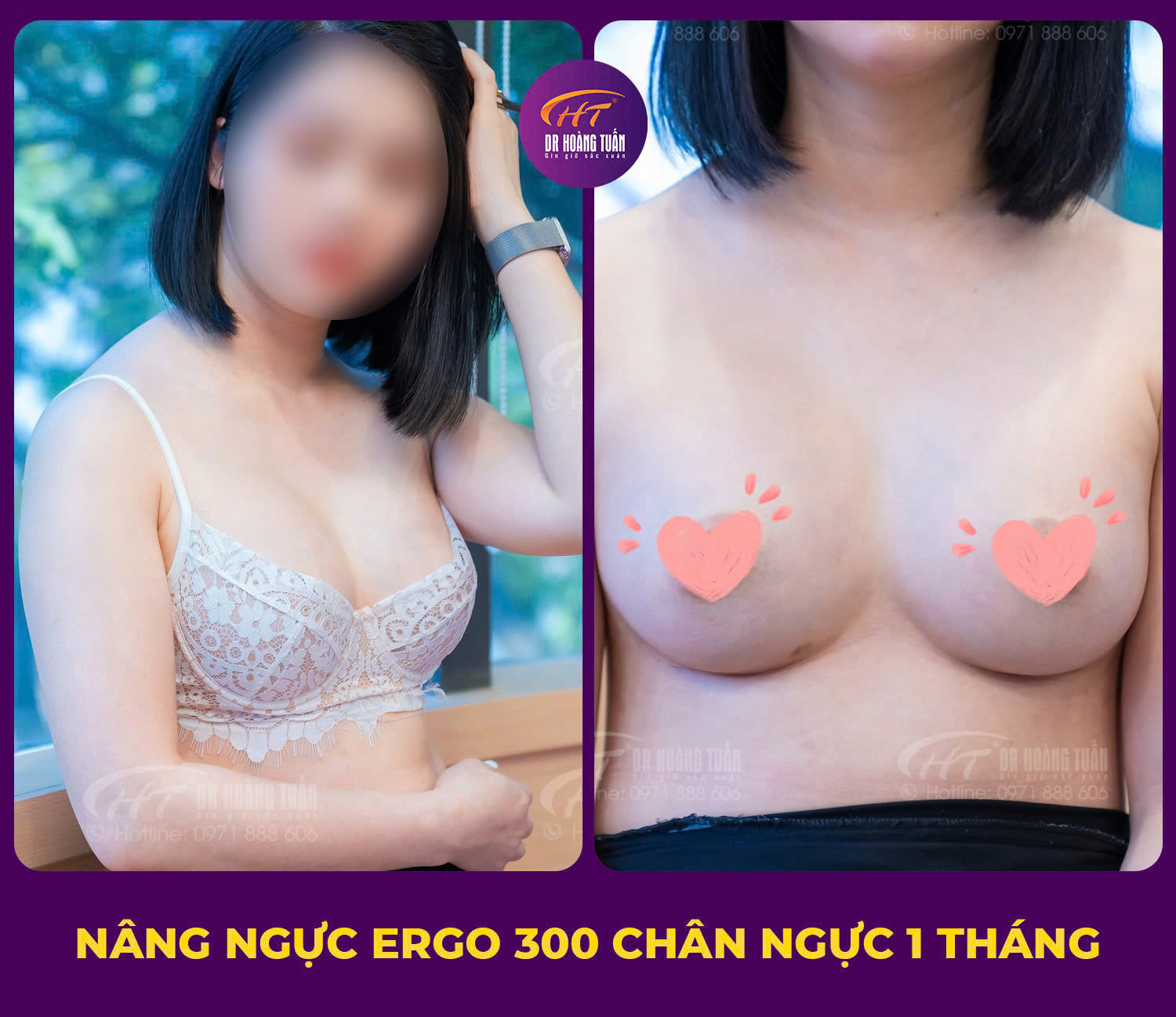 Kết quả nâng ngực đường chân ngực - Dr Hoàng Tuấn